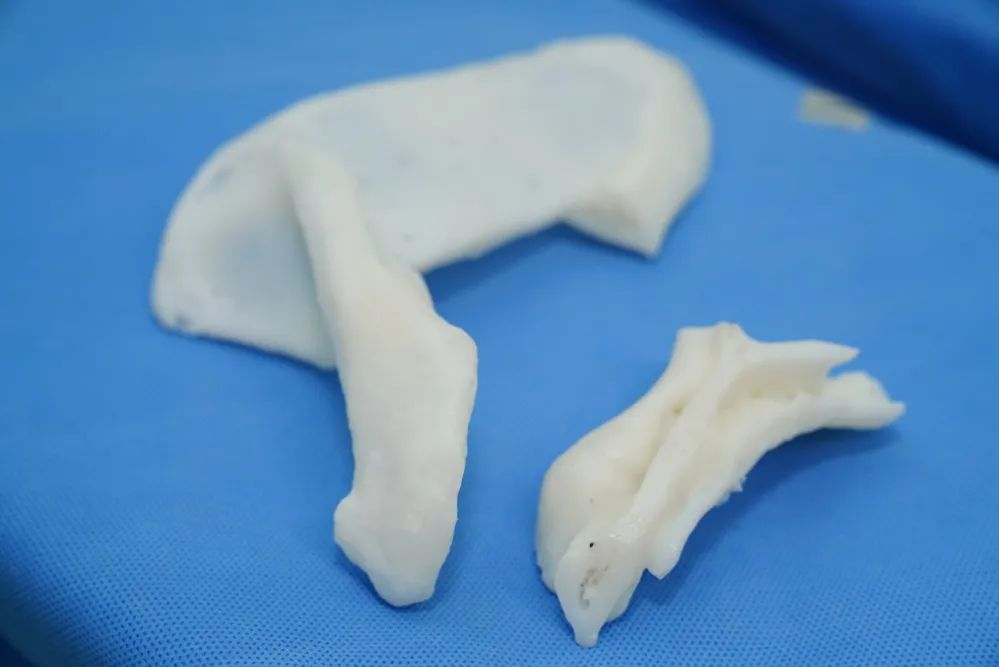 3D打印反肩置换，解决患者疑难复杂肩关节陈旧毁损伤难题